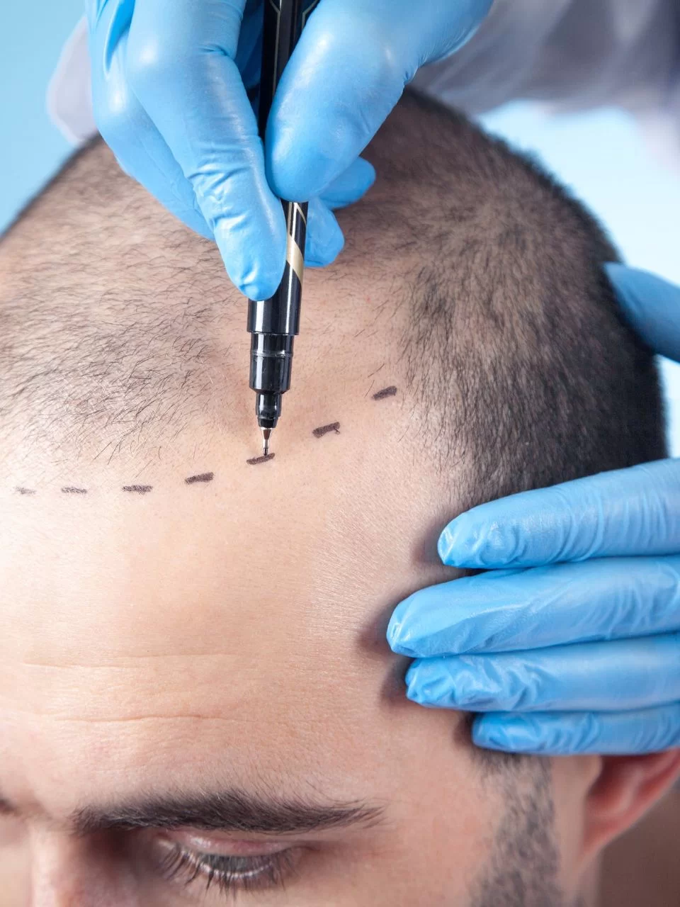 Haartransplantation